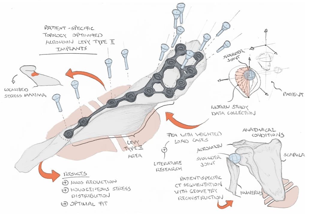 Topology-Optimised Implant